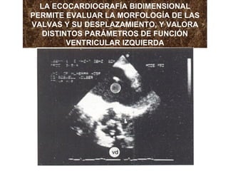 LA ECOCARDIOGRAFÍA BIDIMENSIONAL PERMITE EVALUAR LA MORFOLOGÍA DE LAS VALVAS Y SU DESPLAZAMIENTO, Y VALORA DISTINTOS PARÁMETROS DE FUNCIÓN VENTRICULAR IZQUIERDA 