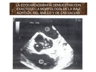 LA ECOCARDIOGRAFÍA DEMUESTRA CON EXACTITUD LA MORFOLOGÍA DE LA RAIZ AORTICA, DEL ANILLO Y DE LAS VALVAS 