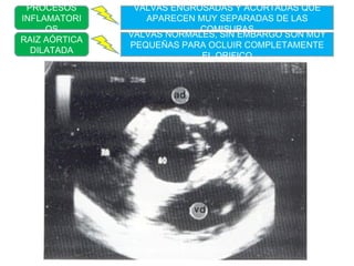 PROCESOS INFLAMATORIOS RAIZ AÓRTICA DILATADA VALVAS ENGROSADAS Y ACORTADAS QUE APARECEN MUY SEPARADAS DE LAS COMISURAS VALVAS NORMALES, SIN EMBARGO SON MUY PEQUEÑAS PARA OCLUIR COMPLETAMENTE EL ORIFICO 