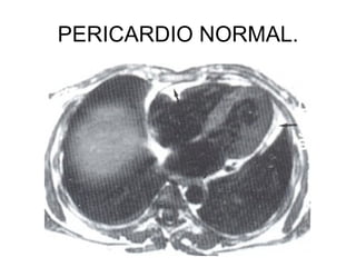PERICARDIO NORMAL. 