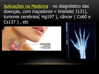 Aplicações na Medicina : no diagnóstico das
doenças, com traçadores = tireóide( I131),
tumores cerebrais( Hg197 ), câncer ( Co60 e
Cs137 ) , etc
 