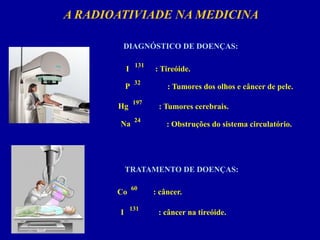 A RADIOATIVIADE NA MEDICINA 
DIAGNÓSTICO DE DOENÇAS: 
131 
I 
: Tireóide. 
32 
P 
: Tumores dos olhos e câncer de pele. 
197 
Hg 
: Tumores cerebrais. 
24 
Na 
: Obstruções do sistema circulatório. 
TRATAMENTO DE DOENÇAS: 
60 
Co 
: câncer. 
131 
I 
: câncer na tireóide.  