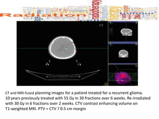 CT and MRI-fused planning images for a patient treated for a recurrent glioma.
10 years previously treated with 55 Gy in 30 fractions over 6 weeks. Re-irradiated
with 30 Gy in 6 fractions over 2 weeks. CTV contrast enhancing volume on
T1-weighted MRI. PTV = CTV ? 0.5 cm margin
 
