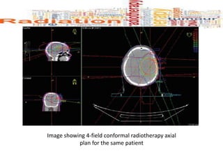Image showing 4-field conformal radiotherapy axial
plan for the same patient
 