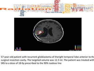 57-year-old patient with recurrent glioblastoma of theright temporal lobe anterior to the
surgical resection cavity. The targeted volume was 12.3 ml. The patient was treated with
SRS to a dose of 18 Gy prescribed to the 90% isodose line
 