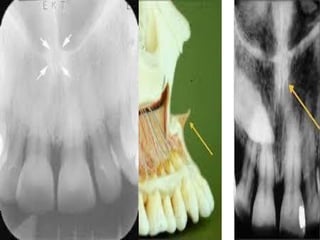 Teeth Radiopeda Radio dental anatomy 6,7 ppt teaching how radio anatomy worksin | PPTX