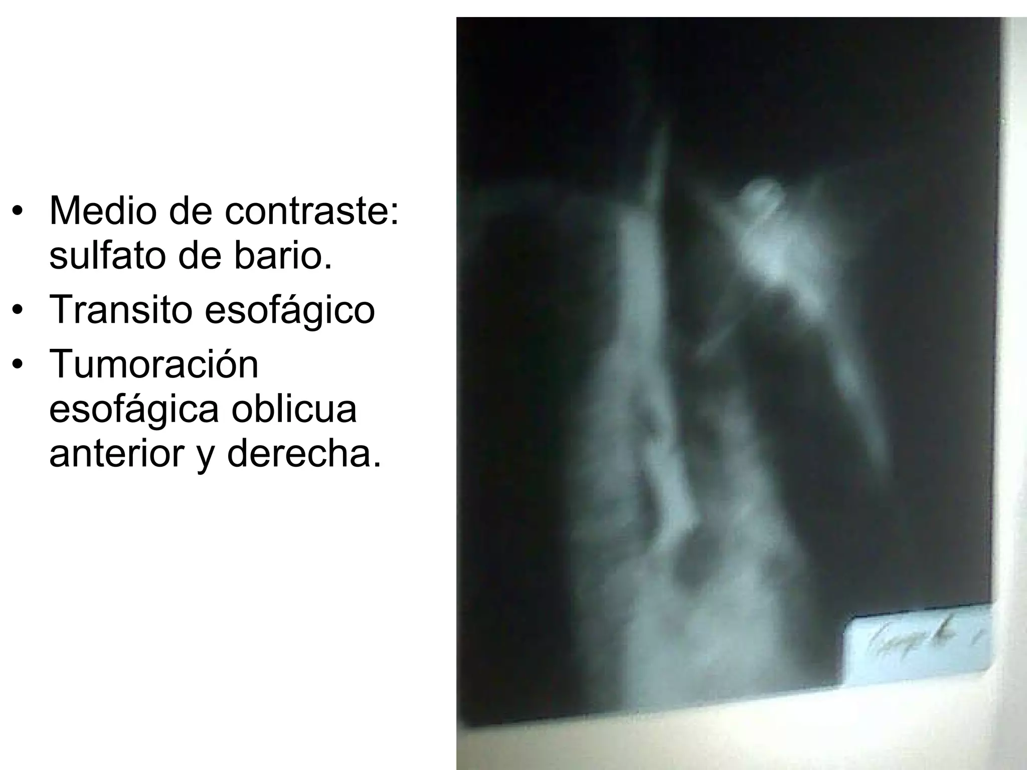 Medio de contraste: sulfato de bario. Transito esofágico Tumoración esofágica oblicua anterior y derecha. 