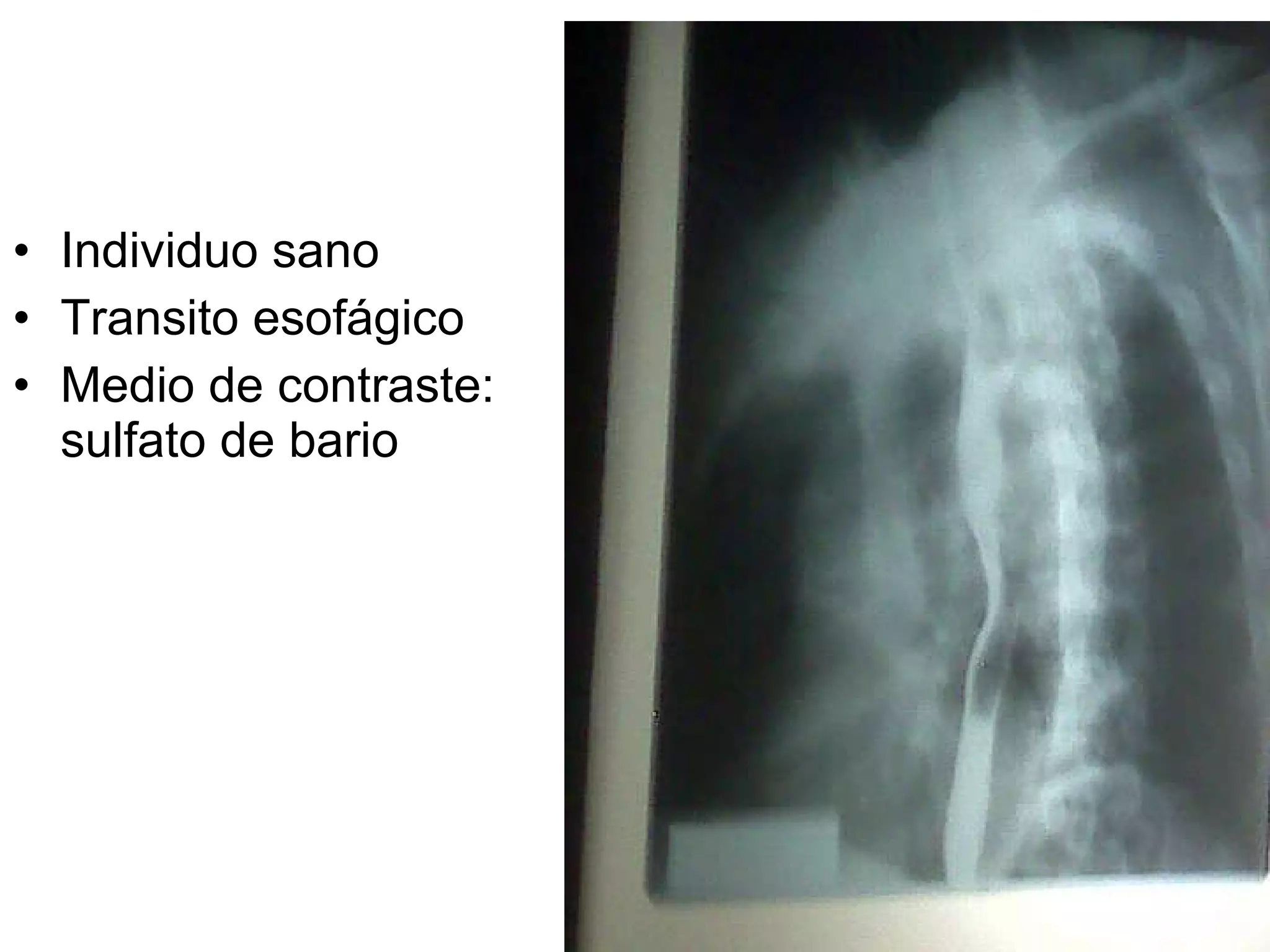 Individuo sano Transito esofágico Medio de contraste: sulfato de bario 