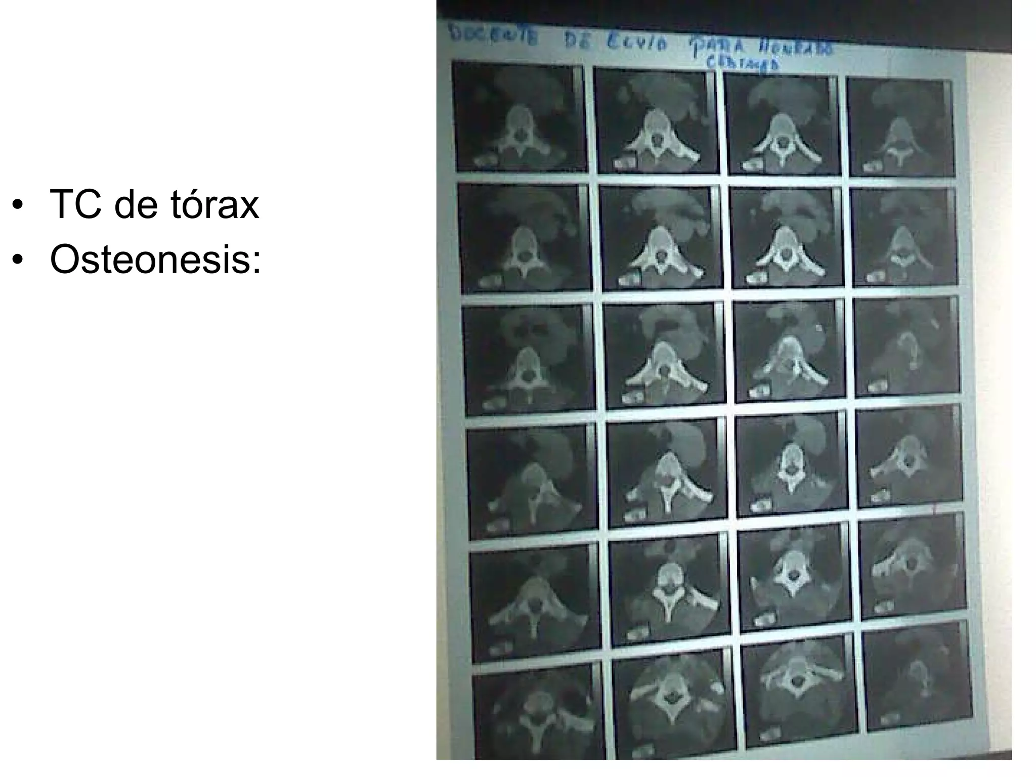 TC de tórax Osteonesis: 