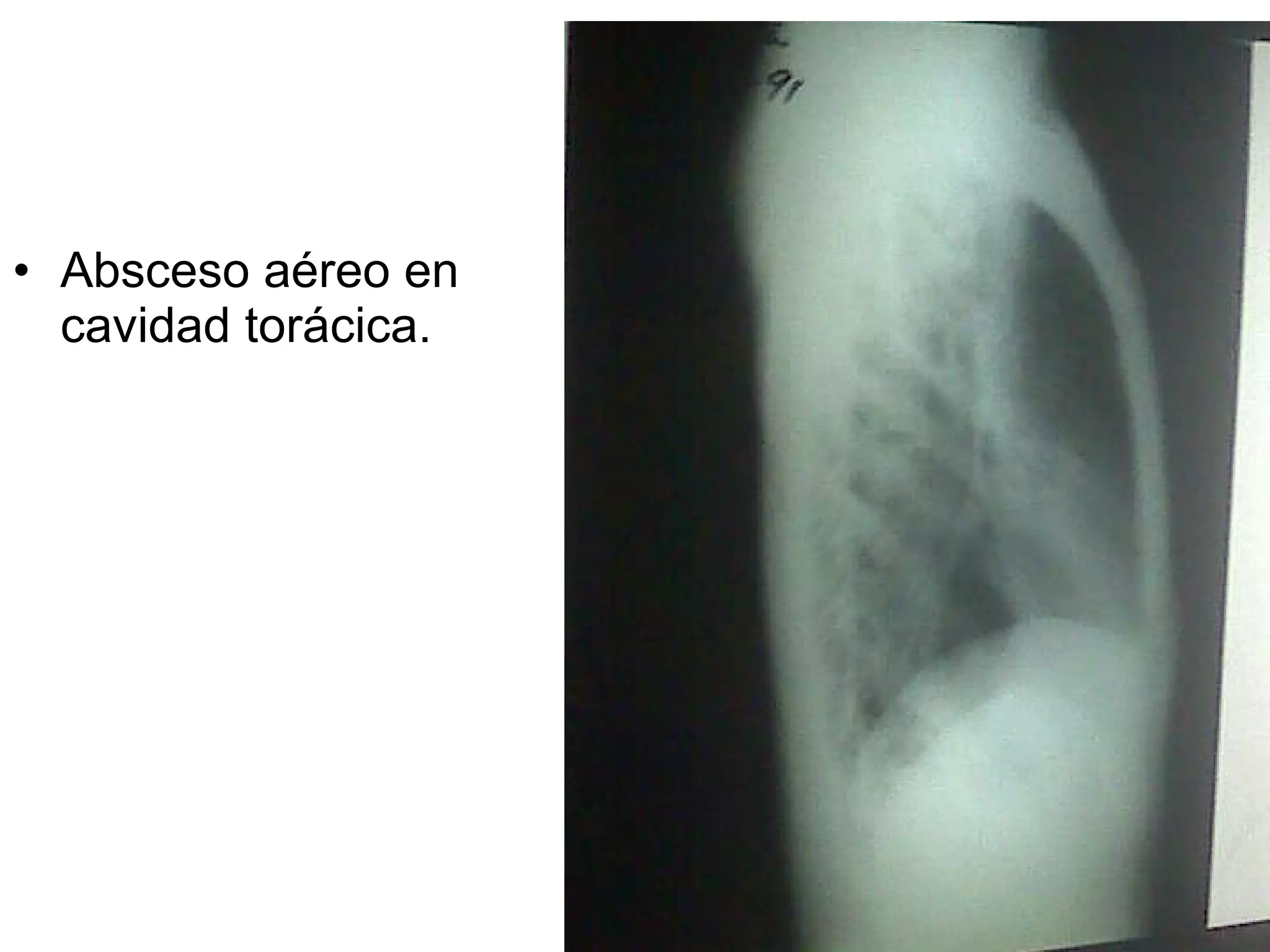 Absceso aéreo en cavidad torácica. 