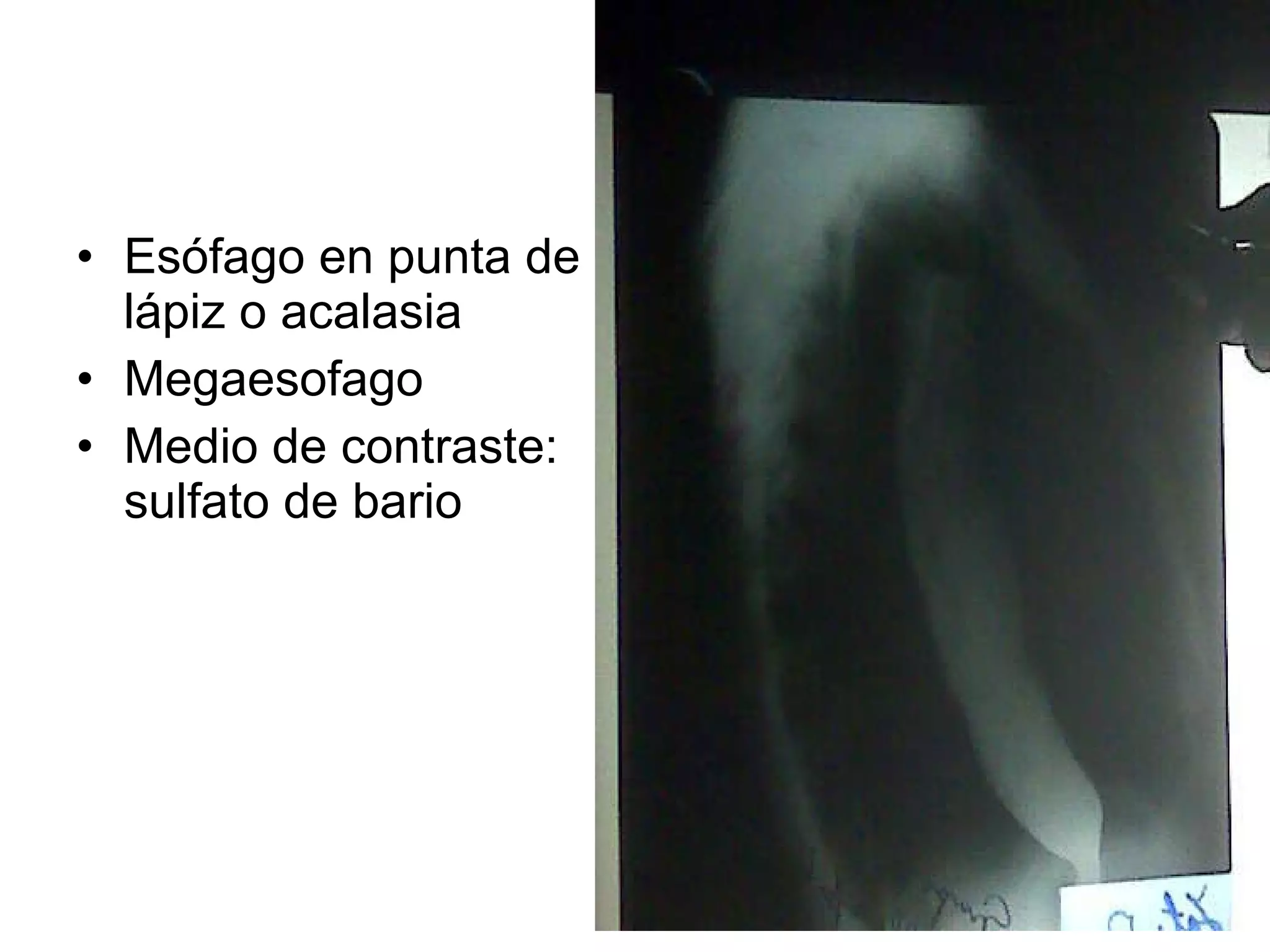 Esófago en punta de lápiz o acalasia Megaesofago Medio de contraste: sulfato de bario 