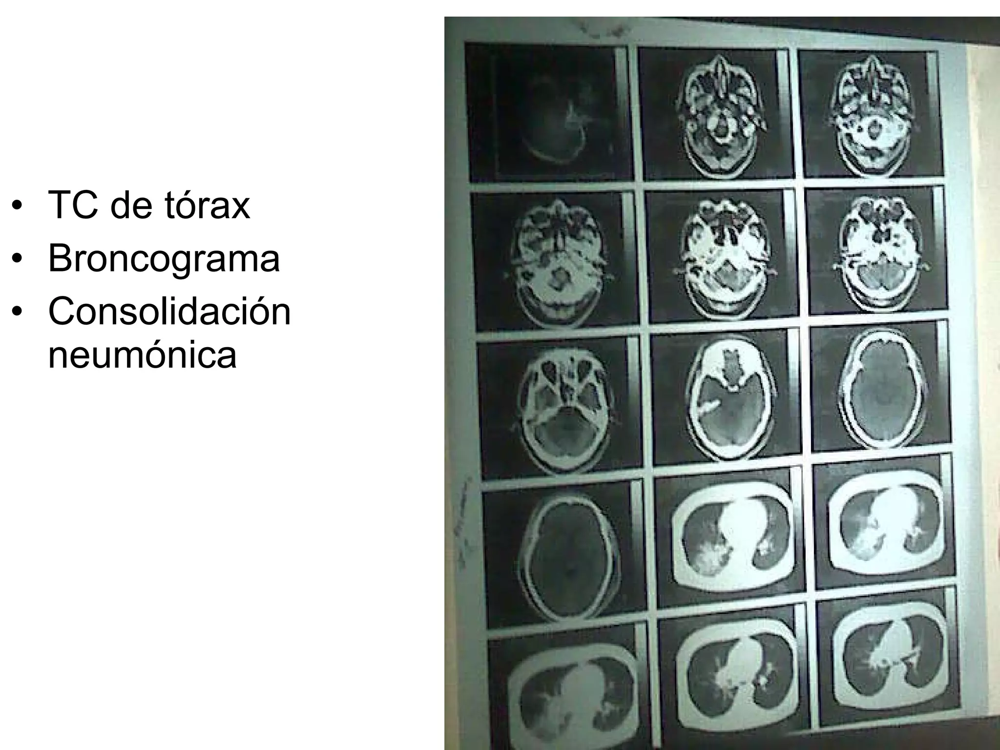 TC de tórax Broncograma Consolidación neumónica 