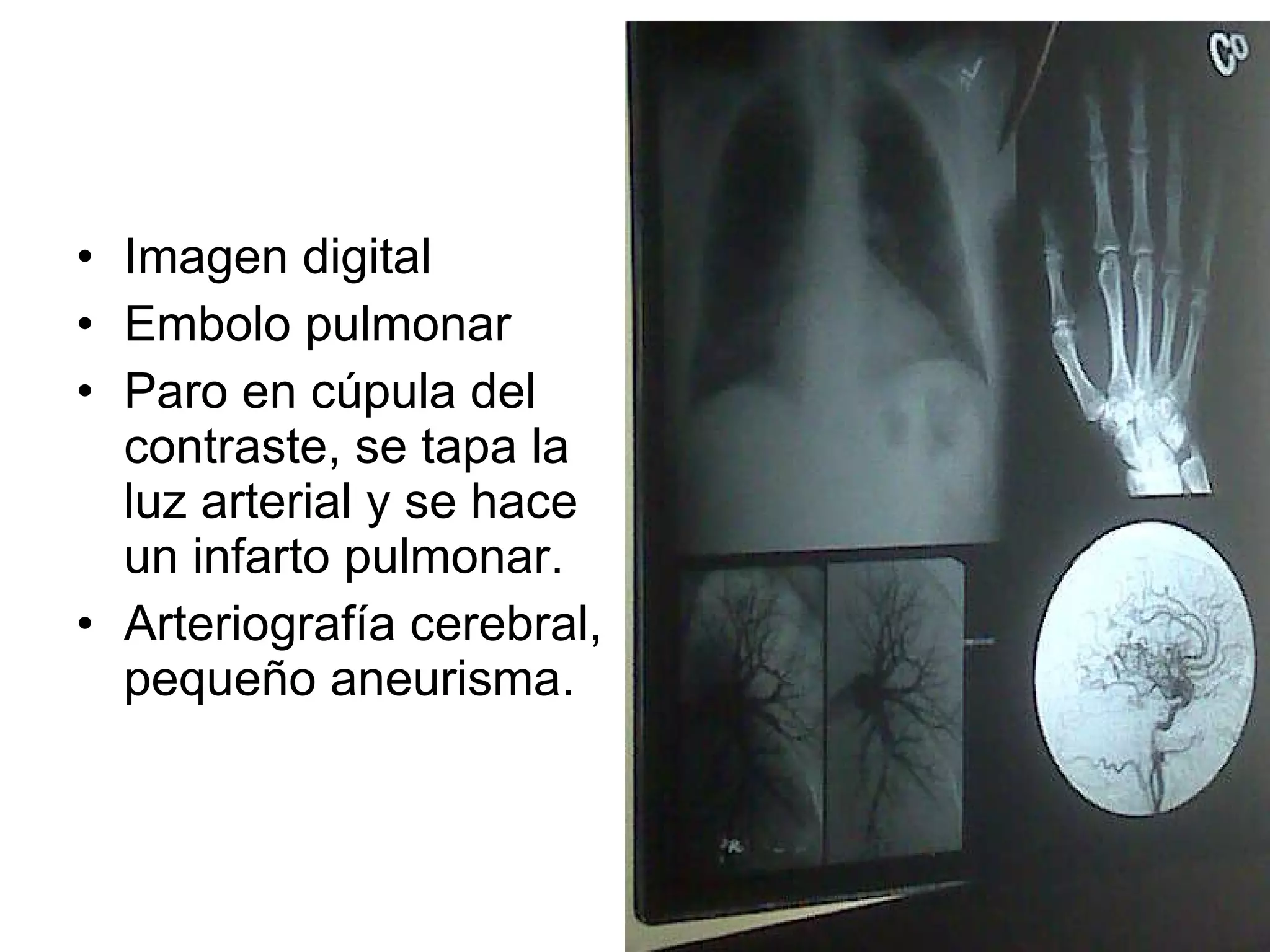 Imagen digital Embolo pulmonar Paro en cúpula del contraste, se tapa la luz arterial y se hace un infarto pulmonar. Arteriografía cerebral, pequeño aneurisma. 