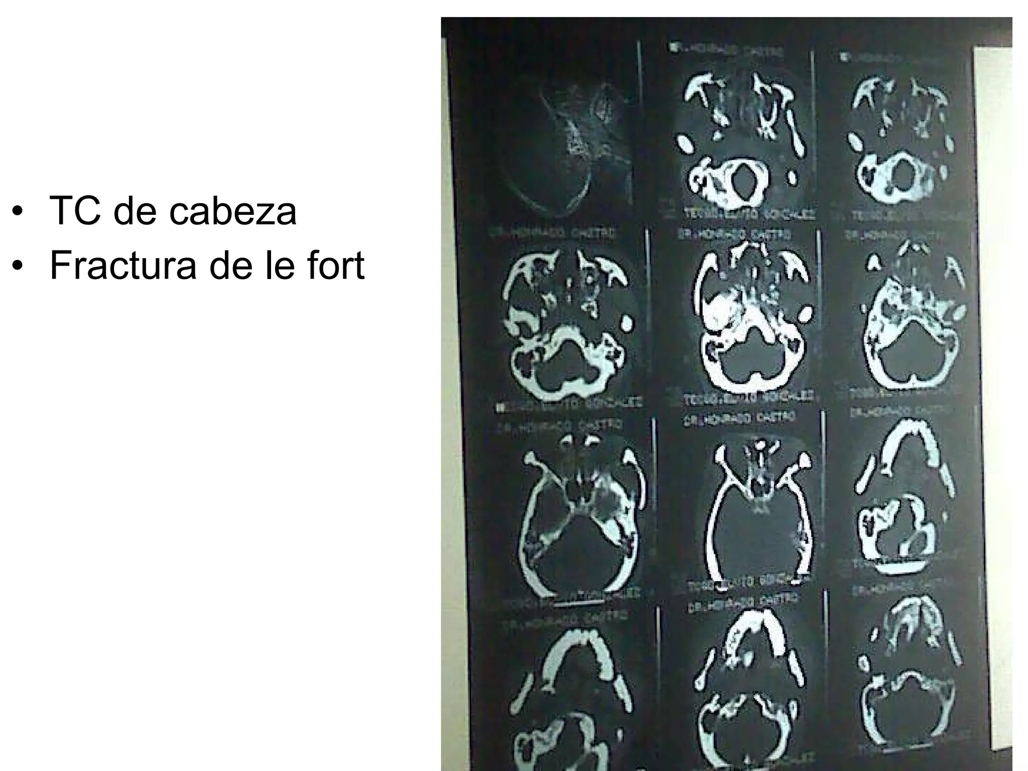 TC de cabeza Fractura de le fort 