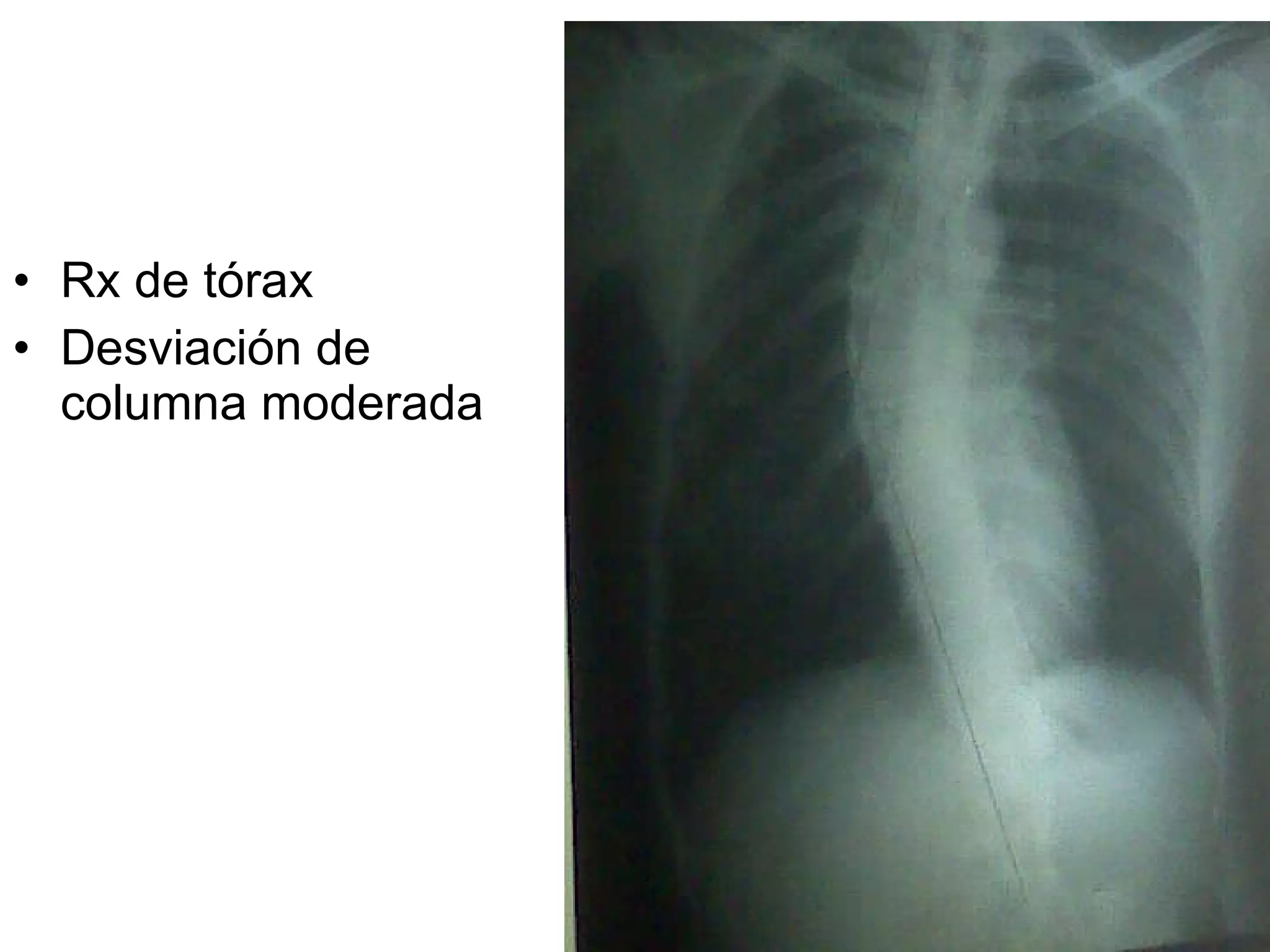 Rx de tórax Desviación de columna moderada 