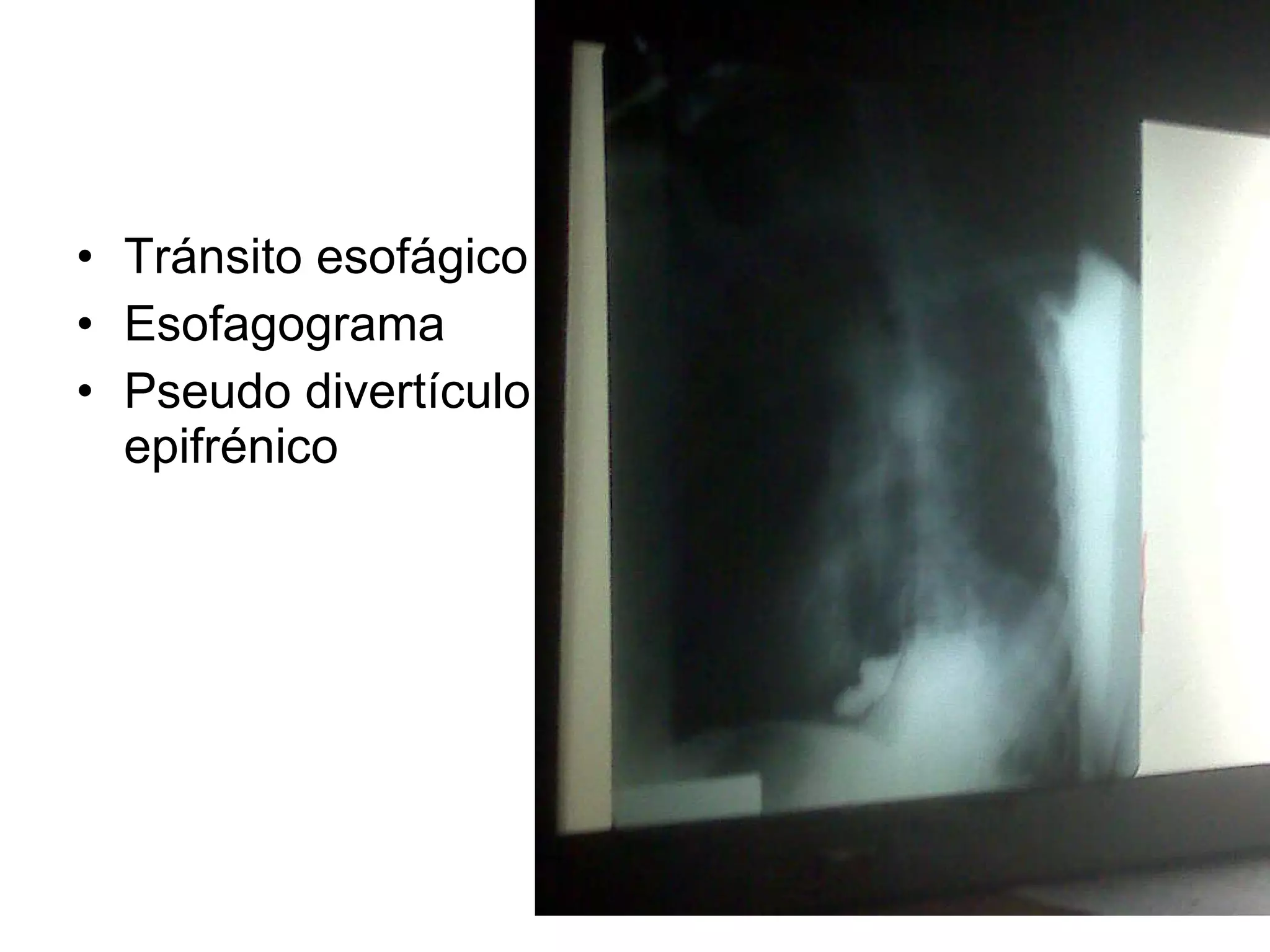 Tránsito esofágico Esofagograma Pseudo divertículo epifrénico 