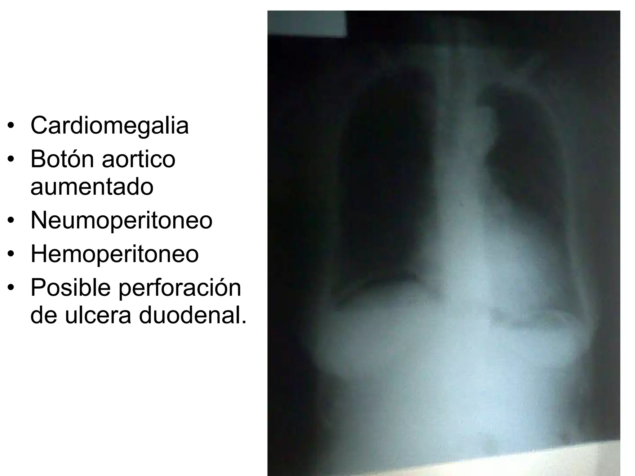 Cardiomegalia Botón aortico aumentado Neumoperitoneo Hemoperitoneo Posible perforación de ulcera duodenal. 