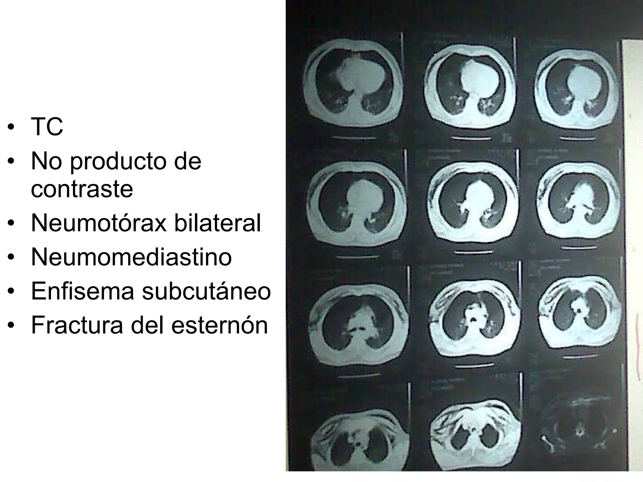 TC No producto de contraste Neumotórax bilateral Neumomediastino Enfisema subcutáneo Fractura del esternón 