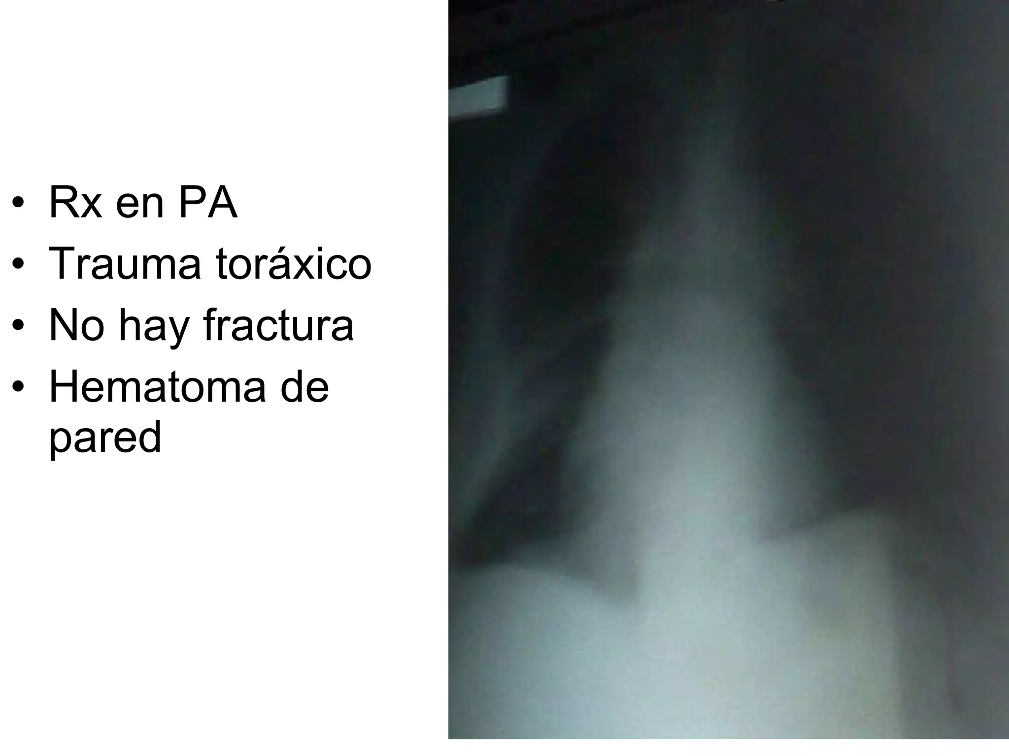 Rx en PA Trauma toráxico No hay fractura Hematoma de pared 