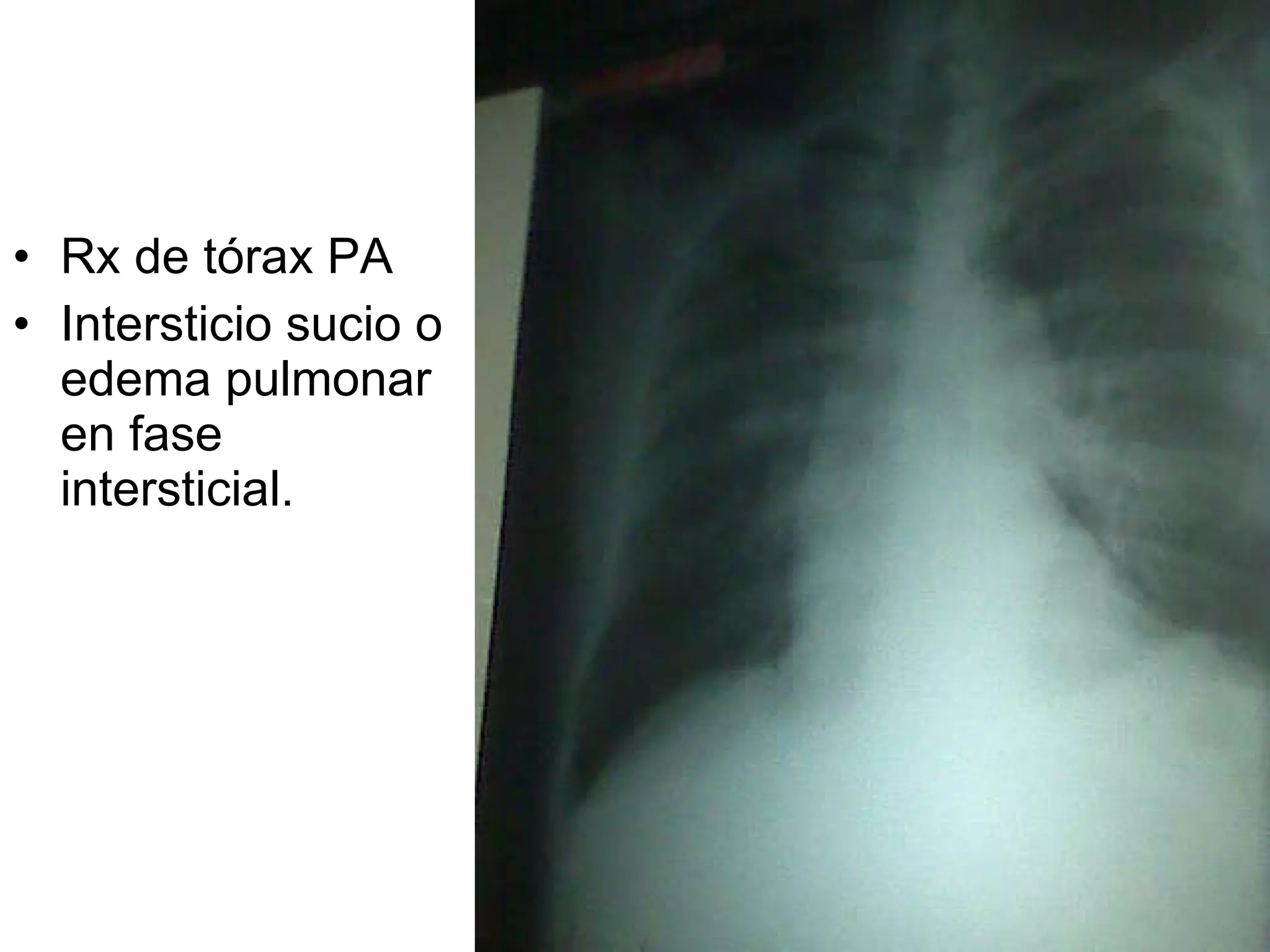 Rx de tórax PA Intersticio sucio o edema pulmonar en fase intersticial. 