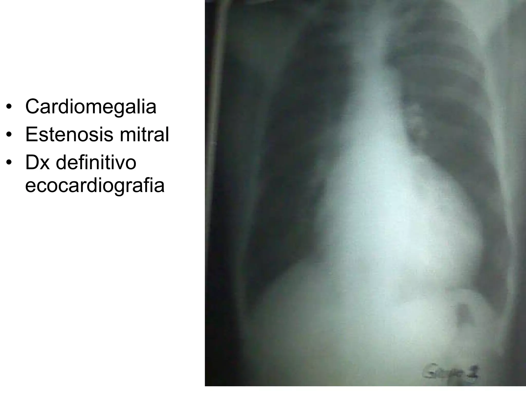 Cardiomegalia Estenosis mitral Dx definitivo ecocardiografia 