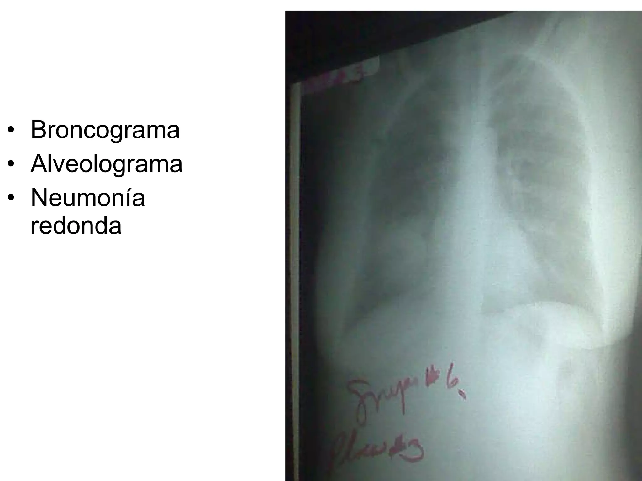 Broncograma Alveolograma Neumonía redonda 