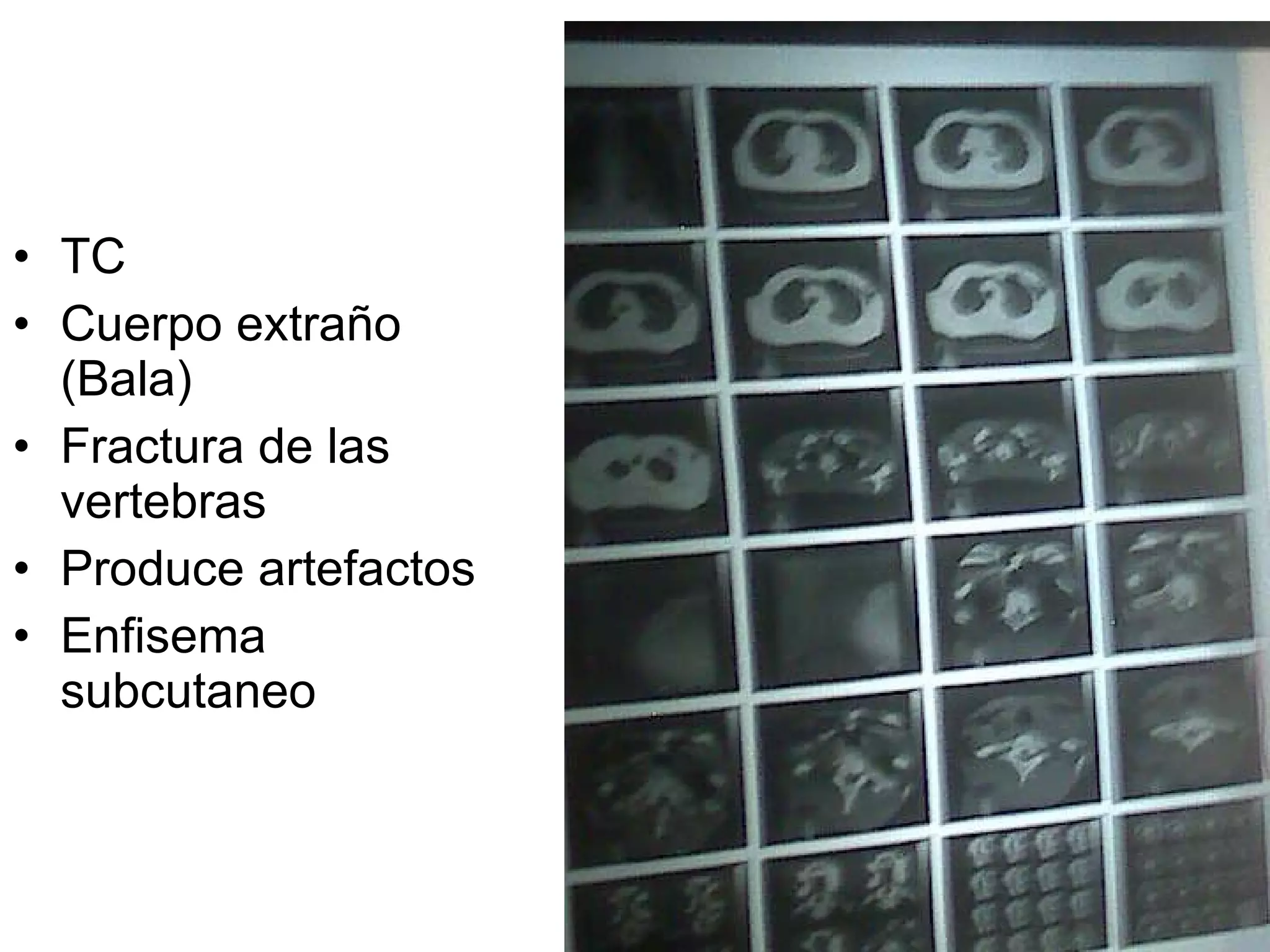 TC Cuerpo extraño (Bala) Fractura de las vertebras Produce artefactos Enfisema subcutaneo 
