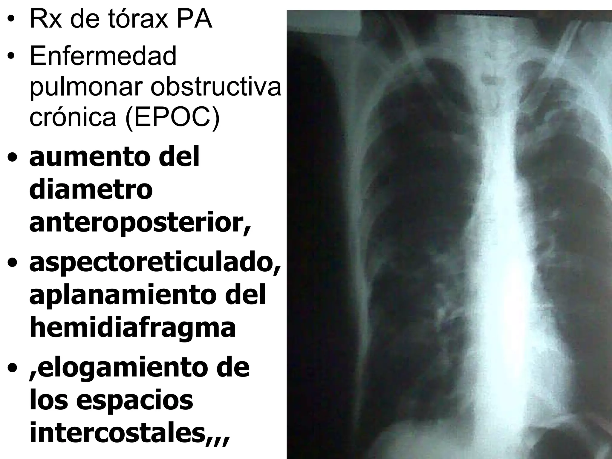 Rx de tórax PA Enfermedad pulmonar obstructiva crónica (EPOC) aumento del diametro anteroposterior, aspectoreticulado,aplanamiento del hemidiafragma ,elogamiento de los espacios intercostales,,, 