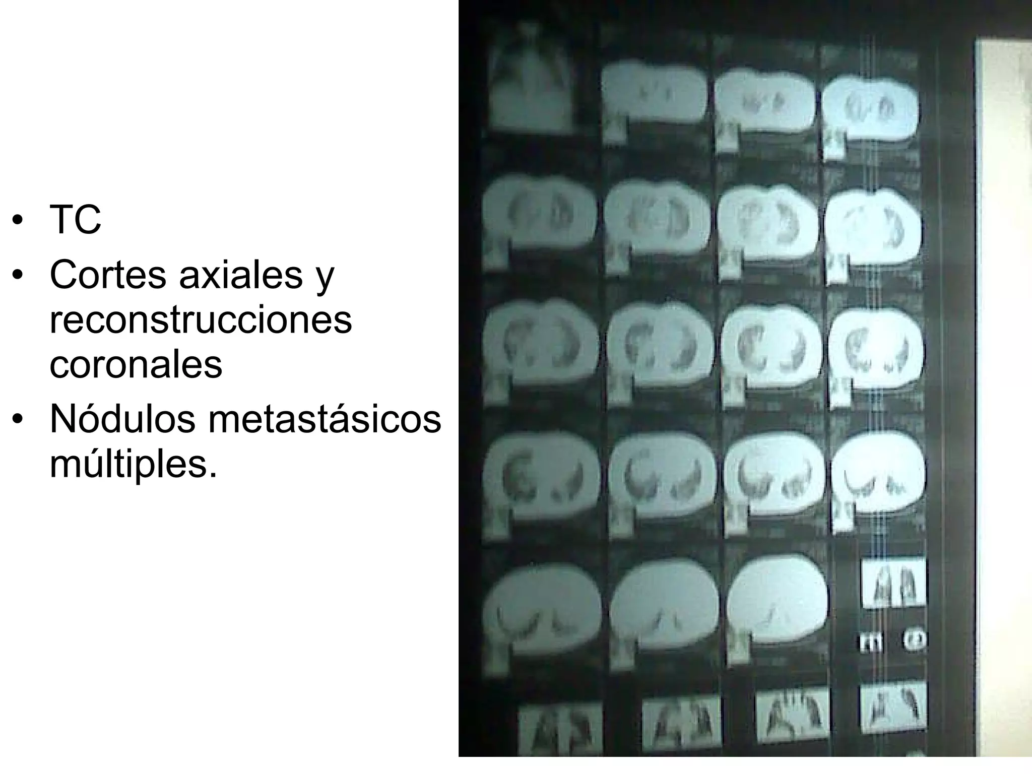 TC Cortes axiales y reconstrucciones coronales Nódulos metastásicos múltiples. 