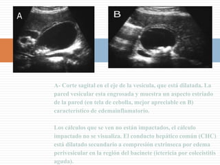 Vesícula de Porcelana
