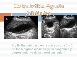 Ileo BiliarCáncer  Vesicula