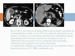 ColelitiasisB- Colecistografía oral: colelitiasis.La vesícula está opacificada, y muestra un defecto negativo que corresponde a un cálculo.El principal problema es que la gran mayoría de las vesículas con colelitiasis (90%) no se contrastan lo suficiente debido a la pérdida de la capacidad de concentración de la pared vesicular por inflamación crónica (exclusión vesicular), por lo que el diagnóstico es indirectoA- Colecistografía oral normal.Antes del US era el examen de elección para visualizar la vesícula. Involucra la ingesta de un medio de contraste por vía oral el cual es concentrado por la vesícula. En la actualidad ha sido reemplazado por la ecografía y no es utilizado por su bajo rendimiento.