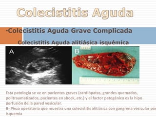 Criterios ecográficos de colelitiasis1- Imágen Ecogénica2-Sombra acústica3-Móvil