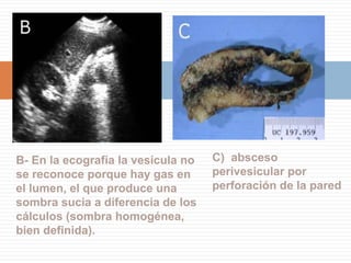Colelitiasis WESEcografía abdominal. Colelitiasis WESEste signo ocurre cuando el lumen de la vesícula se encuentra enteramente ocupada por un gran cálculo o por varios cálculos, de manera que no se identifican como tal ya que no están inmersos en bilisWall: paredEcho: ecoShadow: sombraEstos tres signos juntos son casi patognomónicos de colelitiasis, y permite diferenciarlo de otras entidades que también producen una sombra acústica en el lecho vesicular como vesícula de porcelana, fistula biliodigestiva, colecistitis efisematosa, etc.