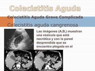 Pólipo Vesicular y Bilis EcogénicaBilis ecogénica o "barro biliar".La bilis se torna ecogénica (normalmente es anecogénica) por la presencia de mucus, cristales, material de detritus, pus, sangre o mezcla de éstas.Causas típicas:- ayuno prolongado- embarazo- colecistitis aguda- hemobilia