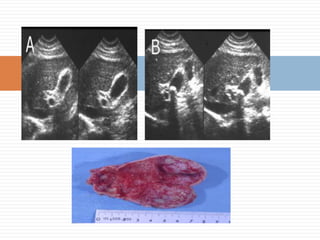 Eco abdominal: pólipo vesicular que se identifica por ser una Imágen ecogénica, sin sombra acústica, inmóvil.Es una lesión muy frecuente, la mayoría de los pólipos son benignos y corresponden a pólipos de colesterol. Es sospechoso cuando mide más de 1cm.