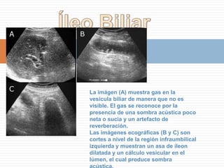 Colecistitis Aguda AlitiásicaA y B- En este caso en la eco se ven sólo 2 de los 5 signos clásicos (bilis ecogénica y engrosamiento de la pared vesicular.)