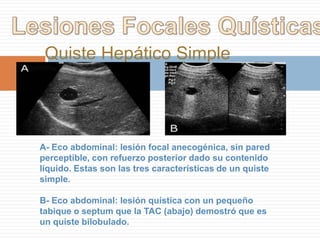 Colecistitis AgudaColecistitis Aguda Grave ComplicadaColecistitis aguda cangrenosaLas imágenes (A,B,) muestran una vesícula que está necrótica y con la pared desprendida que se encuentra plegada en el lúmen.