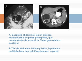 A- Rx simple: vesícula biliar con la pared difusamente calcificadaB- Eco abdominal: gran sombra acústica en el lecho vesicular. La vesícula se identifica parcialmente .No está presente la tríada de la colelitiasis WES (no se peribe el "echo")C- TAC de abdomen: vesícula con la pared engrosada y calcificada.D- Pieza operatoria que muestra la hialinización de la pared con placas calcificadas.