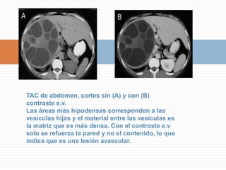 Íleo BiliarLa imágen (A) muestra gas en la vesícula biliar de manera que no es visible. El gas se reconoce por la presencia de una sombra acústica poco neta o sucia y un artefacto de reverberación. Las imágenes ecográficas (B y C) son cortes a nivel de la región infraumbilical izquierda y muestran un asa de ileon dilatada y un cálculo vesicular en el lúmen, el cual produce sombra acústica.