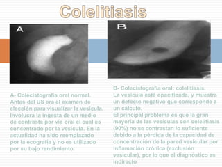 Pólipo y Barro Biliar