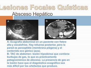 Cáncer VesicularEl cuadro clínico más frecuente es el de una masa palpable en el hipocondrio derecho. Es más frecuente en mujeres (3:1) y es la causa más frecuente de muerte por cáncer digestivo en mujeres Tiene una estrecha relación con la presencia de litiasis y en su mayoría corresponden a adenocarcinomas. Su pronóstico es muy malo ya que en general el diagnóstico es tardío.