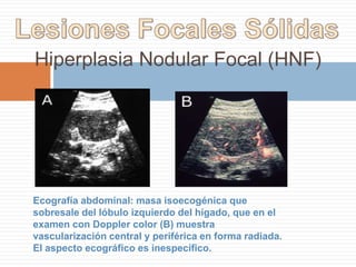 El cáncer vesicular tiene distintas etapas de progresión, pero la presentación más frecuente es de una masa que remplaza totalmente la vesícula e infiltra al hígado, casi siempre asociado a colelitiasis.Mucho menos frecuente es poder visualizar el tumor dentro de la vesícula sin que la haya remplazado.Eco abdominal: se ven masas intravesiculares de distinto tamaño.A- Masa ecogénica en el bacinete de 2 cm aprox. A pesar de lo pequeña de la lesión , la vía biliar extra hepática está dilatada (12 mm), secundario a infiltración tumoral, por lo que el tamaño de la lesión no tiene directa relación con el grado de extensión tumoral.B- Masa ecogénica en el bacinete de 4 cm aproximadamente.C- Masa ecogénica en el bacinete >5 cm .En el cáncer vesicular casi siempre se encuentra colelitiasis asociada (en la primera ecografía abajo no se aprecia el cálculo debido a que se encuentra en otro plano)La forma más frecuente de presentación es la de una masa que reemplaza la vesicula e infiltra el hígado (Imágen inferior) y los cálculos quedan atrapados.