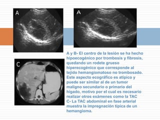 CIRROSIS -HPLesiones Focales QuísticasQuiste Hepático SimpleA- Eco abdominal: lesión focal anecogénica, sin pared perceptible, con refuerzo posterior dado su contenido líquido. Estas son las tres características de un quiste simple.B- Eco abdominal: lesión quística con un pequeño tabique o septum que la TAC (abajo) demostró que es un quiste bilobulado.