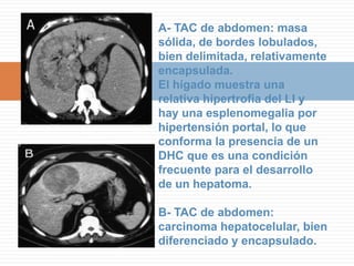 Lesiones Focales QuísticasQuiste HidatídicoEl aspecto que puede tener un quiste hidatídico en eco, TAC o RM puede ser cualquiera de los siguientes:UNILOCULAR