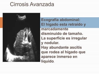 TAC de abdomen, cortes sin (A) y con (B) contraste e.v.Las áreas más hipodensas corresponden a las vesículas hijas y el material entre las vesículas es la matriz que es más densa. Con el contraste e.v solo se refuerza la pared y no el contenido, lo que indica que es una lesión avascular.