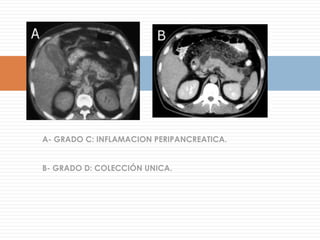Lesiones Focales SólidasHemangiomaGeneralidades:TUMOR BENIGNO MAS FRECUENTE ( 1-10% )