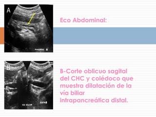 LOCALIZACION HABITUAL: LOBULO DERECHOEl aspecto de un Hemangioma en una eco abdominal se ve:LESION HIPERECOGENICA ( 75% )