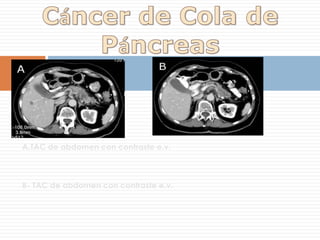 REFUERZO POSTERIOR ( 77% )