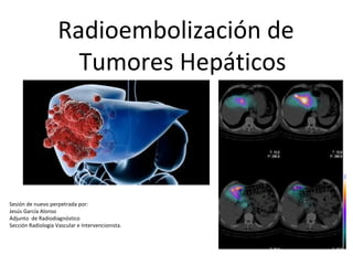 Radioembolización de
Tumores Hepáticos
Sesión de nuevo perpetrada por:
Jesús García Alonso
Adjunto de Radiodiagnóstico
Sección Radiología Vascular e Intervencionista.
 